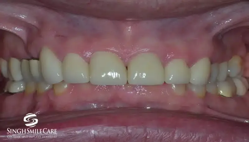 After treatment