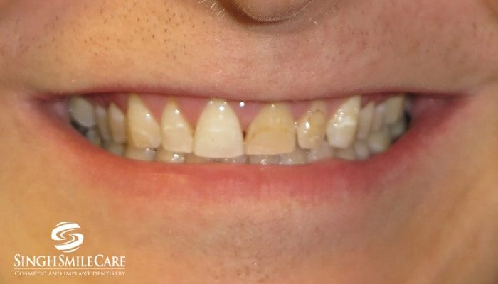 Before treatment