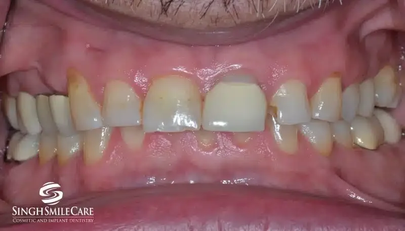 Before treatment