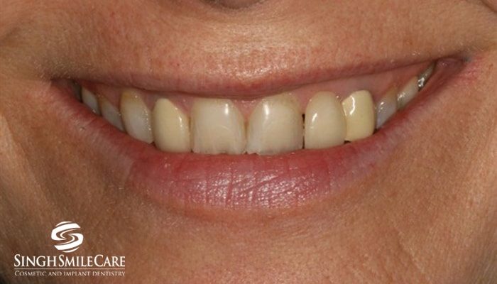 Before treatment