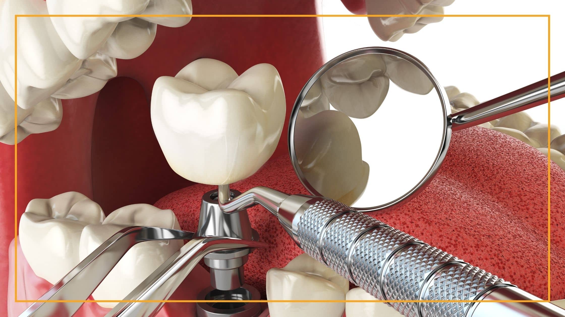 Getting a Dental Implant - Singh Smile Care - Dentist Glendale, AZ