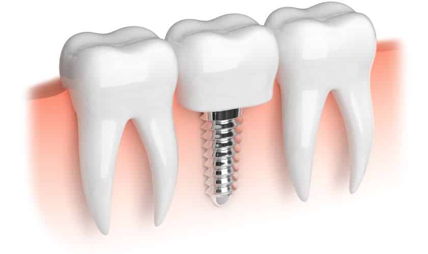 Implant Dentist in Glendale Treating Dental Implant