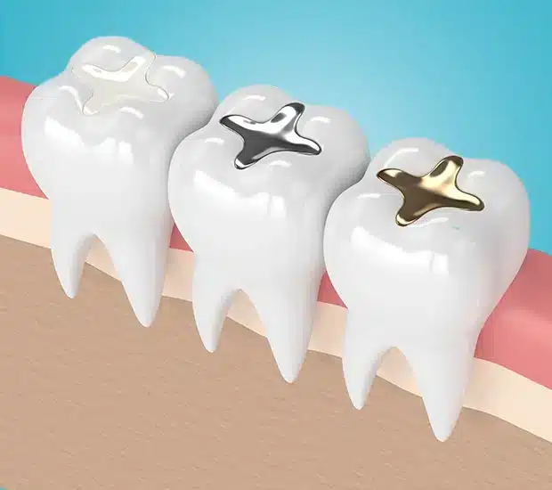 composite fillings glendale