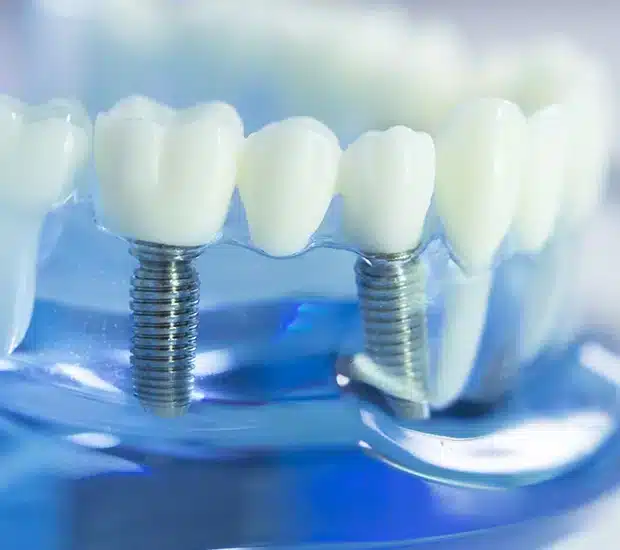 dental implants glendale