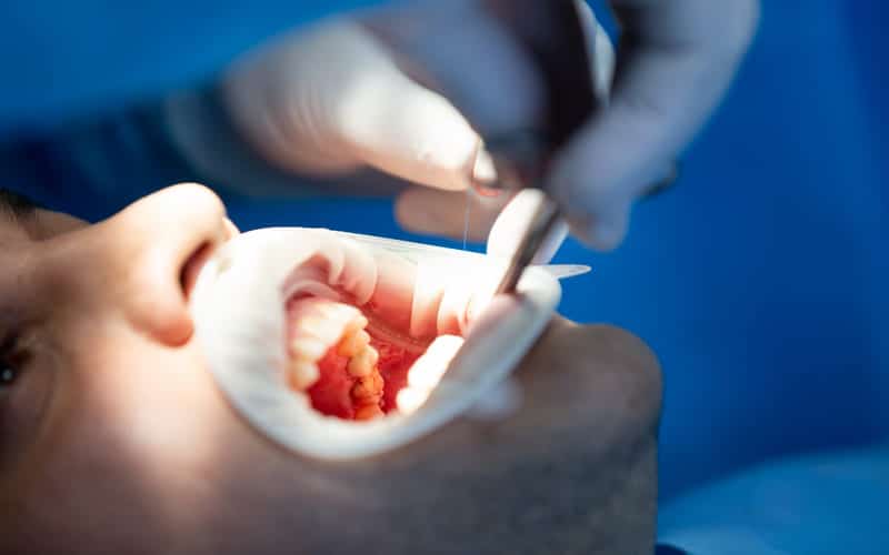 restrictions after tooth extraction