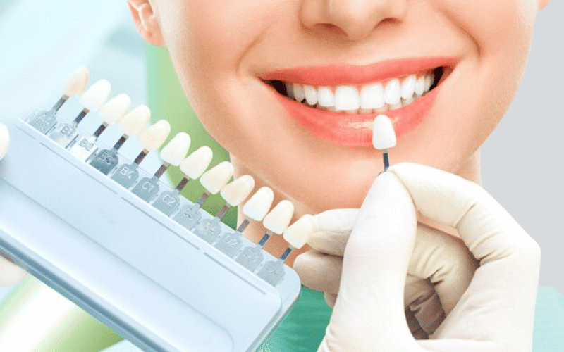 Featured image for “Should I Get Dental Veneers or Dental Bonding?”