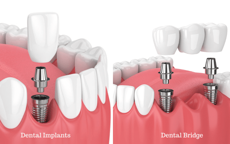 Featured image for “Why Is A Dental Bridge Better Than Dental Implant?”