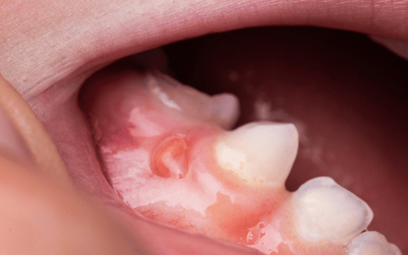 Featured image for “Can Periodontitis Cause Heart Problems?”
