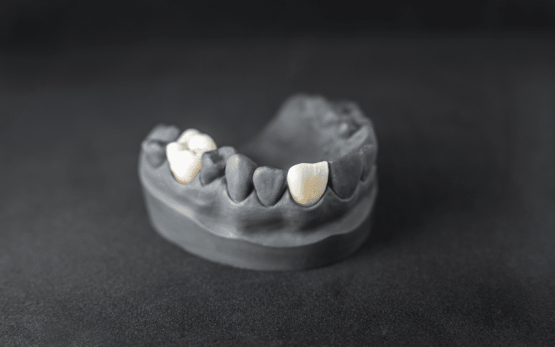 Featured image for “Why Are Dental Crowns So Expensive?”