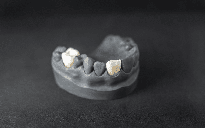 Dental Crowns