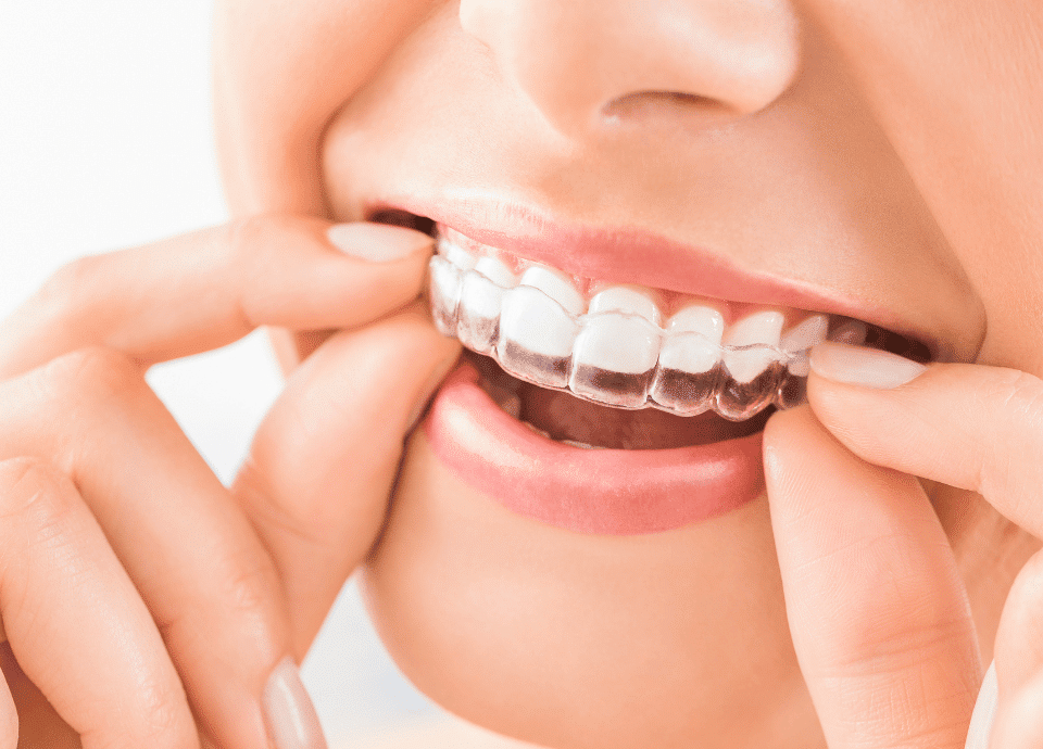 Achieving Your Dream Smile With Six-month Smiles