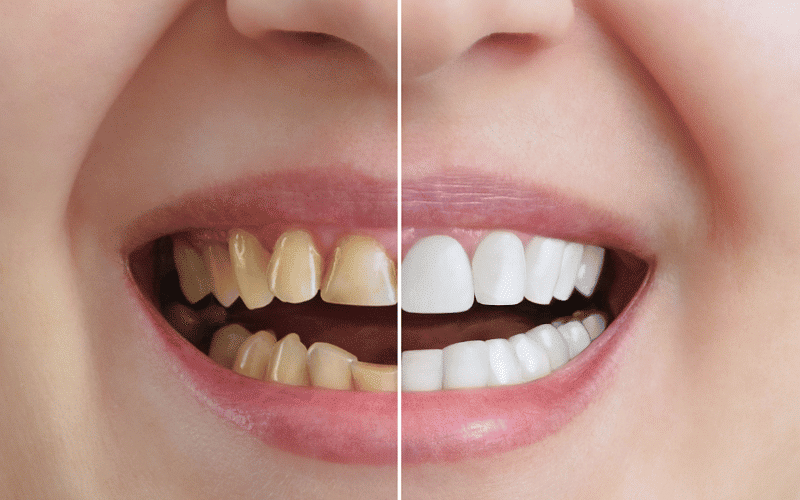 Is Zoom Whitening Better Than Other Teeth Whitening Methods