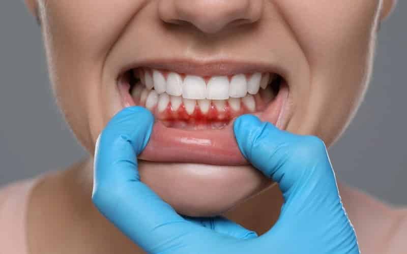 Soft Tissue Grafting for Receding Gums